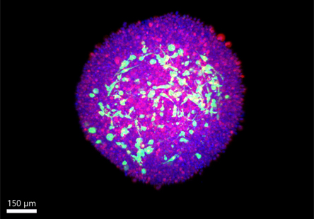 3-D glioma spheroid developed as a model to study interactions among cancer (red) and senescent (green) cells (visualized by light sheet microscopy; cell nuclei in blue).