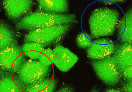 Demonstration of thermotherapy by gold nanorods (yellow) in cancer cells induced by near infrared light (920 nm) produced by femto second laser. Cell death by apoptosis (blue circle) and necrosis (red circle) were detected by membrane blebbing and loss of calcein fluorescence (green), respectively.
