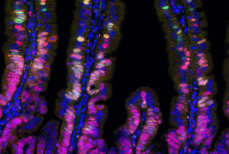 Fluorescenční mikrofotografie dokumentující heterogenitu transformovaných buněk v časných fázích vzniku nádoru.