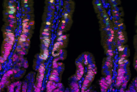 Fluorescence microphotography documenting the heterogeneity of transformed cells in the early stages of tumour formation.