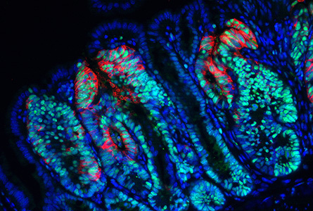 Fluorescenční mikrofotografie epiteliálních buněk obarvených na proliferační marker PCNA (zelený fluorescenční signál) a buněk pozitivních na protein Trop2 (červený fluorescenční signál) v nádorech tenkého střeva vzniklých u pokusné myši 6 týdnů po inaktivaci nádorového supresoru Apc; vzorek byl kontrastně obarven DAPI (modrý fluorescenční signál v jádře).