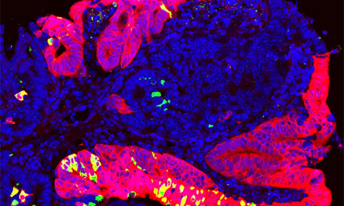 Intestinal tumor, Dapi (Blue; nuclei), ID4 (Green; secretory cells) and Trop2 (Red; tumor cells )