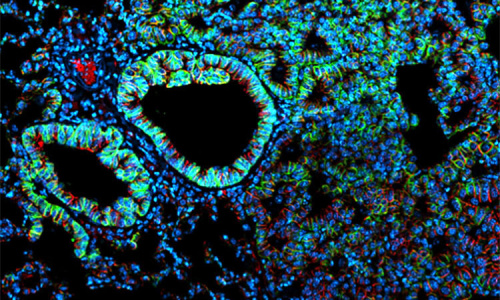 Myší plíce s nádorem, Dapi (modrá; jádro), EpCam (zelená; epitelové buňky) a PCNA (červená; proliferující buňky)